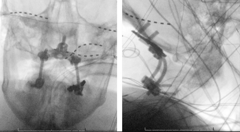 Right Vertebral Artery Compression Syndrome 1