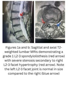 Figures 1a and b Sagittal and axial T2-weighted lumbar MRIs demonstrating a grade 1 L2-3 spondylolisthesis (red arrow) with severe stenosis secondary to right L2-3 facet hypertrophy (red arrow). N (1)
